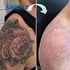 Super Picosecond Picolaser Tatoo Remover Q Switched Pico Second Laser Tattoo Removal Machine